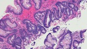 barretts oesophagus summary.jpg