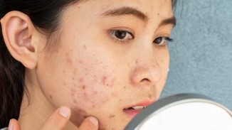 Acne 1280.jpg